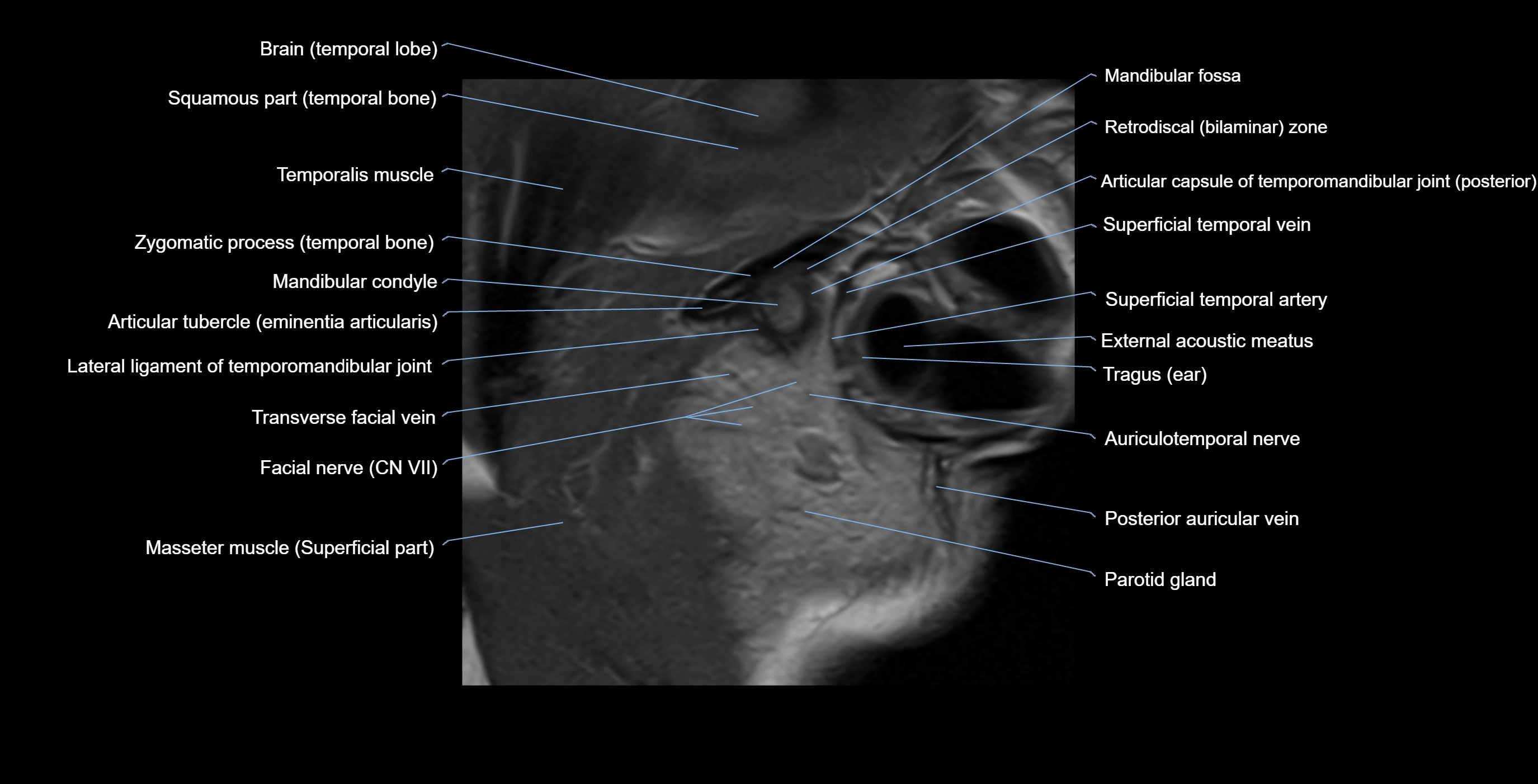 MRI TMJ sagittalclosed  mouth cross sectional 3T anatomy -img-00001-00004.webp